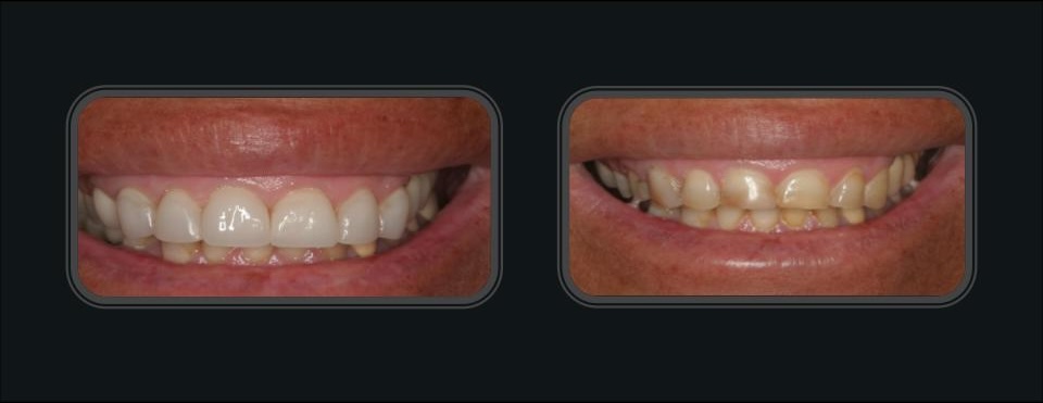 לפני ואחרי מקרה 5